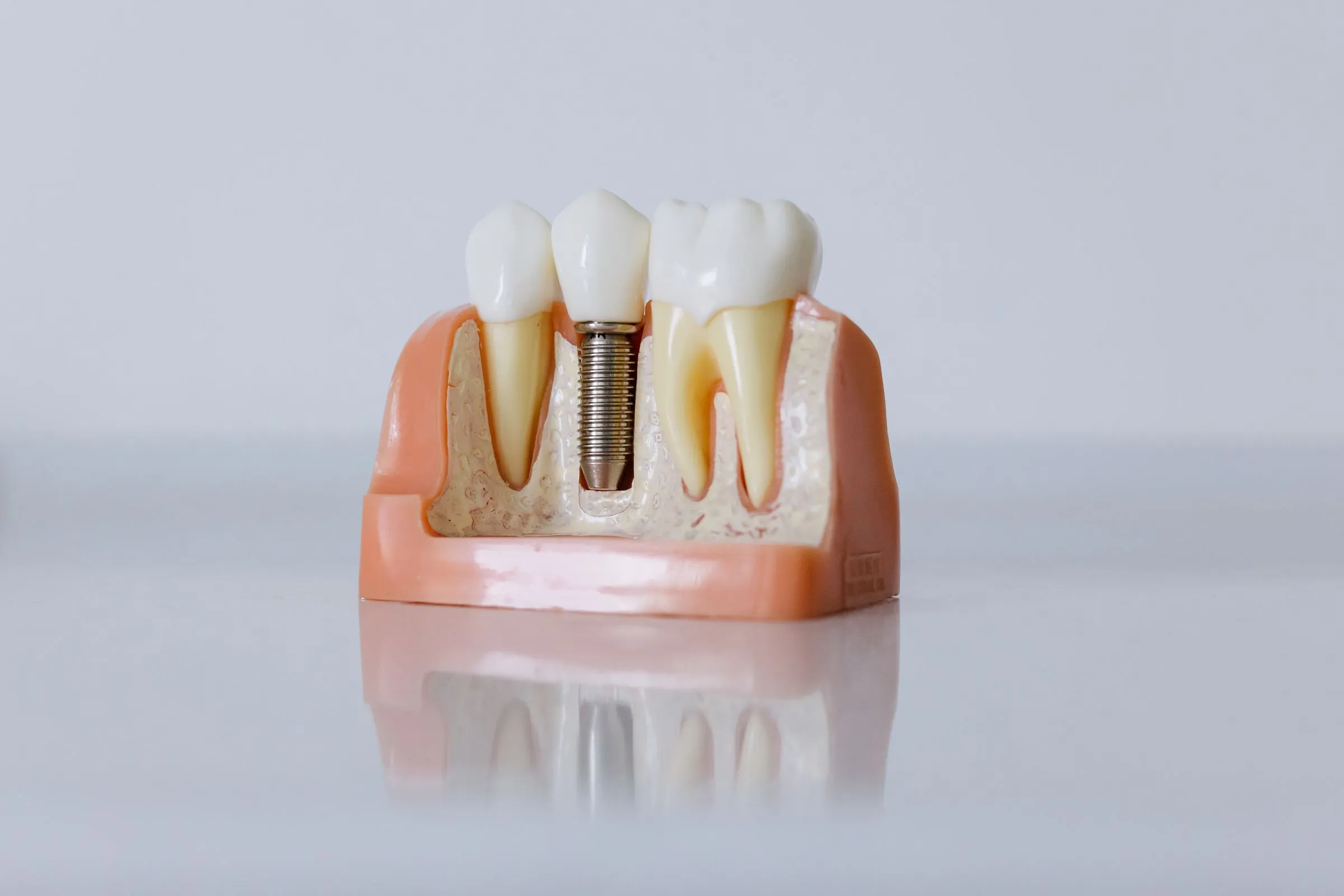 A dental model showing an implant post in the jaw with a crown on top, beside natural teeth